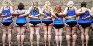 Lipedema, Manga Gástrica